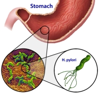 3 stressz es a helicobacter_200x188.jpg